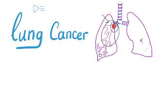 Lung Cancer | The most COMPREHENSIVE Explanation
