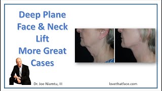 Deep Plane Facelift More Great Cases