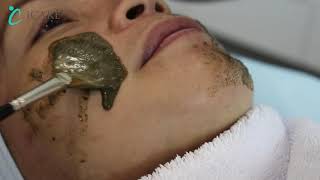 green peeling ما هو التقشير بالأعشاب