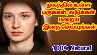 முகத்தில் உள்ள பருக்கள், மருக்கள் மறைய இத செய்யுங்க,( EASY HOME REMEDIES FOR PIMPLES )