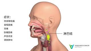 Mandarin/ Simplified Chinese - What is Oropharyngeal Cancer? Signs \u0026 Symptoms. Tonsil Cancer.