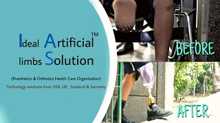 07835880155 Transparency in process followed at Ideal Artificial limbs Solution