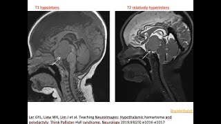 79. Hypothalamic hamartoma, tuber cinereum hamartoma; gelastic seizures, ciliopathy, SHH, endocrine