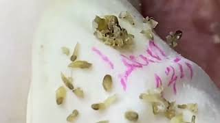 Relaxing Acne \u0026 Blackhead Removal | Satisfying Pimple Popping #9