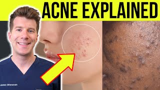 Doctor explains ACNE | Causes, symptoms, treatment and more!