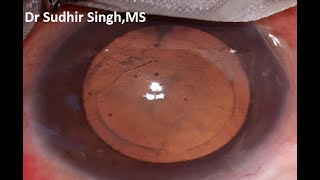 SICS In A Cataract With Pseudo Exfoliation (Unedited) HD