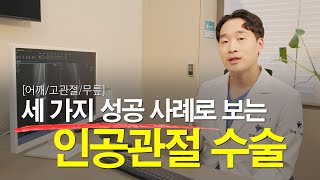 인공관절 수술!!  무릎/고관절/어깨  성공적인 수술 사례로 인공관절 수술에 대해 이야기해보자!