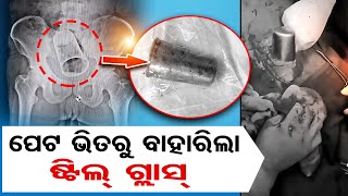 ମଳଦ୍ଵାରରୁ ଯାଇ ପେଟଭିତରେ ଷ୍ଟିଲ ଗ୍ଲାସ || Doctors Remove Glass From Patient's Stomach || Odisha Reporter