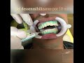 Passo a passo clareamento dental de consultório.