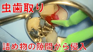 虫歯取り。詰め物の隙間から虫歯の侵入。Dental Caries