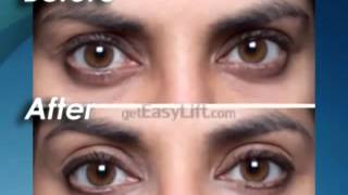 EasyLift Instant Eye Lift - Before \u0026 After