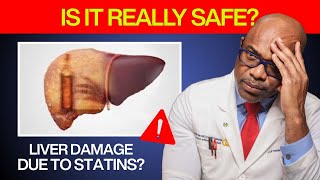 Do Statins Cause Liver Damage? Doctor Explains the Truth About Side Effects