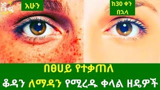 Ethiopia:- በፀሀይ የተቃጠለ  ቆዳን ለማዳን የሚረዱ ቀላል ዘዴዎች | Nuro Bezede Girls