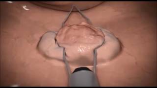 Endoscopic Mucosal Resection EMR of Polyps Animation - Korean