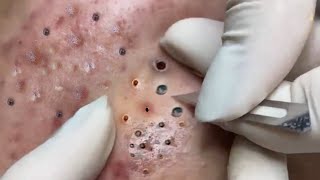 Treatment of Blackheads and Hidden Acne at Sac Dep Spa #127