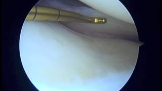 GA L Knee ACL reconstruction 5 28 15