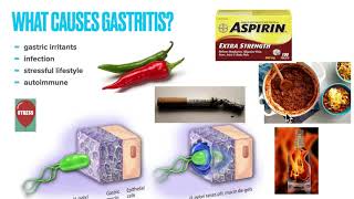 Chronic Gastritis: Causes, Symptoms, Treatment,  Prevention, Why treatment fails and How to fix it!!