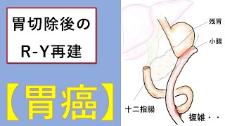 なぜ、こんなに複雑！　胃がん術後の、RY再建法を超簡単に【医師解説】2023年