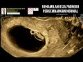 Kehamilan 7 minggu normal