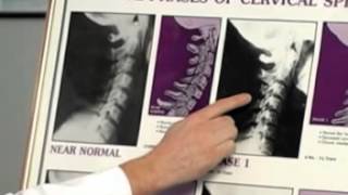 Neck X-rays. Car Accident. Chiropractic Care Columbus Ohio Dr. Van Such