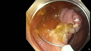 Cecal Polyp EMR