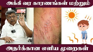 அக்கி வர காரணங்கள் மற்றும் அதற்கான எளிய சிகிச்சை முறை  Cure Shingles|  Sarvam