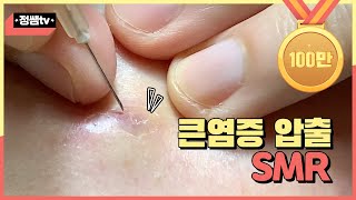 [압출smr] 4탄!! feat. 큰 염증