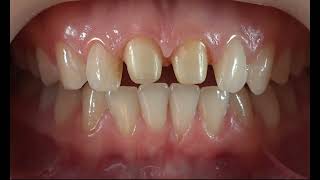 Tooth preparation for zirconia: 8 parameters