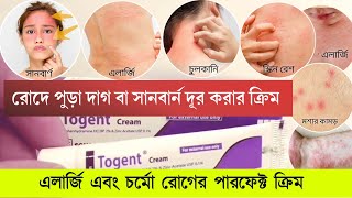 এলার্জি,চুলকানি,সানবার্ণ,স্কিন রেশ জন্য ১০০% কার্যকরি একটি ক্রিম | Togent Cream