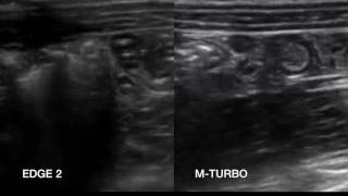 Normal Appendix: Edge 2 Vs. M-Turbo