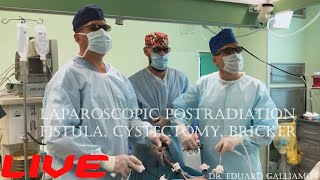 Lap. Postradiation fistula, cystectomy, Bricker / Лучевой уретропузырновлаг свищ,цистэктомия,Бриккер