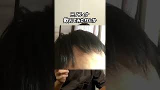 AGAな人達に贈る植毛した話