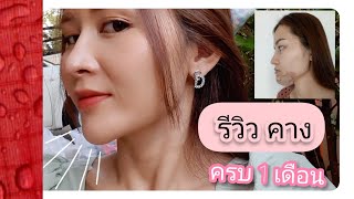 เสริมคาง  รีวิวคางครบ 1 เดือน | Mamy mind 4