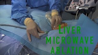 Liver microwave ablation of a sub capsular HCC with Ultrasound