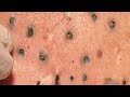 HUGE BLACKHEADS SUCCESSFULLY REMOVED SUFFER FOR HOW MANY YEARS