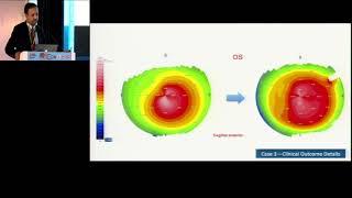 AIOC2019 GP098 Topic 10  Cross linked lenticule implantation for keratoconus :   Dr  Rajesh Fogla