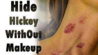 How To Hide A Hickey | How to remove love bite in 24 hours