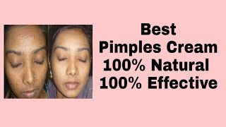 #Pimples ని ఎప్పటికి  తిరిగి రాకుండా ఎలా  తగ్గించుకోవాలి తెలుగులో