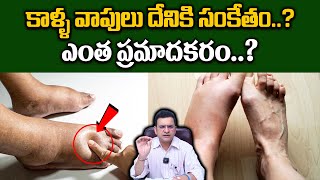 Dr Movva Srinivas : కాళ్ళ వాపులు దేనికి సంకేతం..? ఎంత ప్రమాదకరం..? | Leg Swelling@dr.movvasrinivas