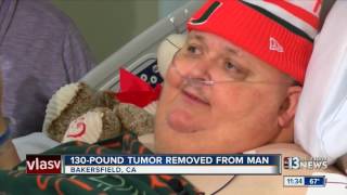 130-pound tumor removed from man