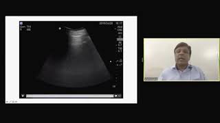 1 Stepwise management of acute pancreatitis   Dr Pramod Garg