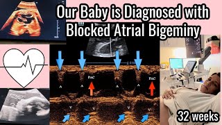 How serious is Blocked Atrial Bigeminy in a fetus. Babies with irregular heartbeats, discussion.