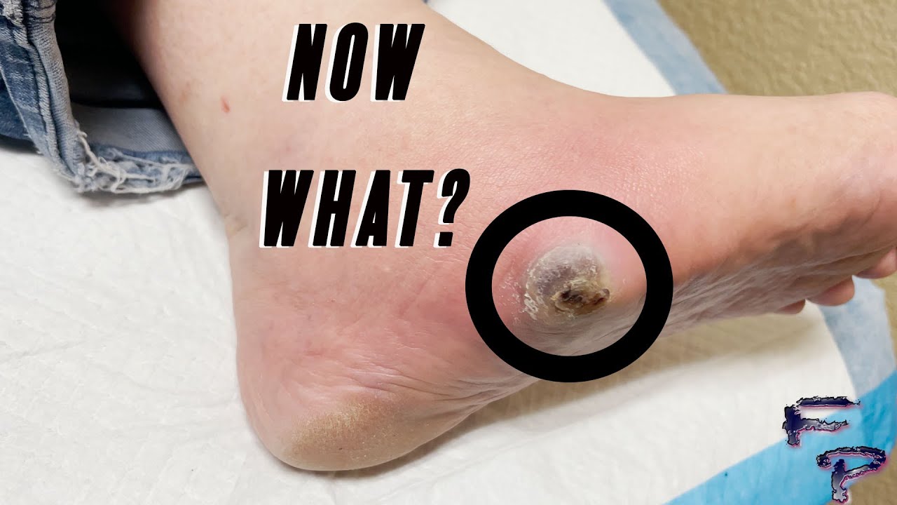 Infected Blister Treatment - YouTube