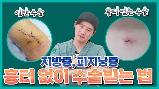 흉터 없이 수술하는 방법이 있다고? (feat. 지방종, 피지낭종)