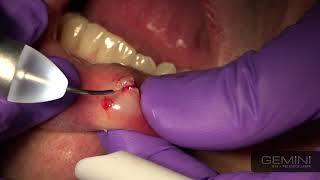 Mucocele removal with Gemini diode laser | Dr. Ed Kusek