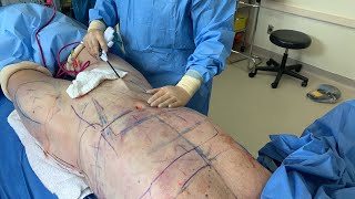 RENUVION INTERNAL HEATING TO FIX BOTCHED LIPOSUCTION AND MALE SIX PACK OF THE STOMACH|Dr. Jason Emer