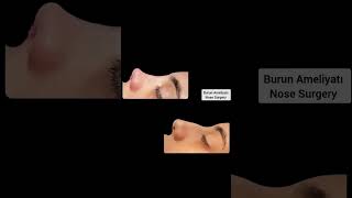 Burun Estetiği Ameliyatı, Nose Aesthetic Surgery