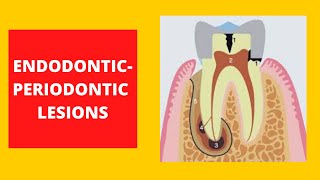 Endodontic-Periodontic Lesions -Operative