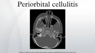 Periorbital cellulitis