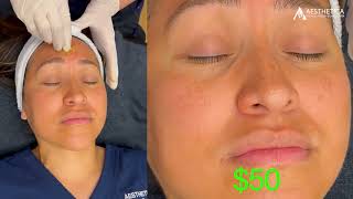 The Chemical Peel Myth You Need to Stop Believing! | #Aesthetica